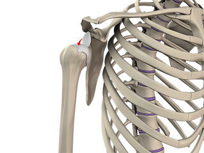 Shoulder Dislocation - Educational Picture