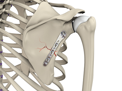 Shoulder Fracture Care - Educational Picture