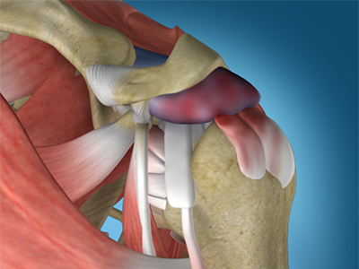 Shoulder Impingement - Educational Picture