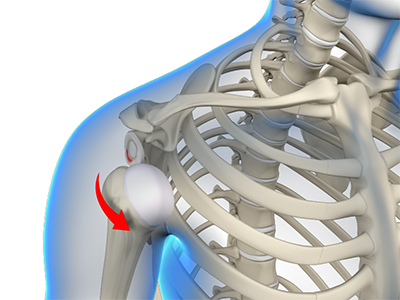 Shoulder Instability - Educational Picture