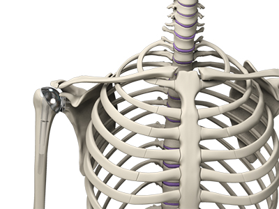 Shoulder Joint Replacement - Educational Picture