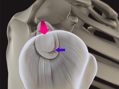 Shoulder Labral Tear with Instability - Educational Picture