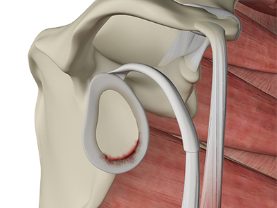 Shoulder Labral Tear - Educational Picture