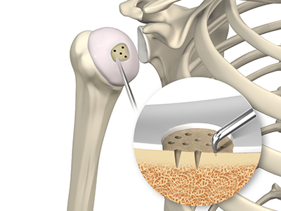 Shoulder Preservation Surgery - Educational Picture