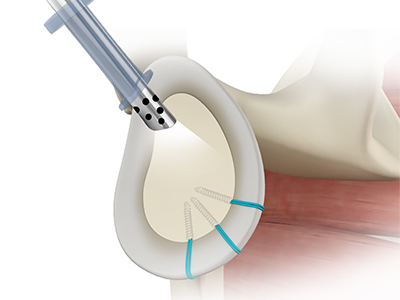 Shoulder Reconstruction Surgery - Educational Picture