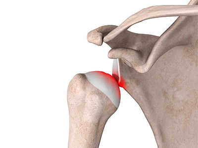 Shoulder Stabilization - Educational Picture