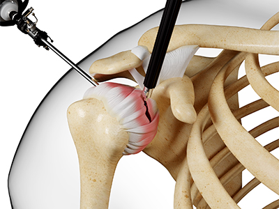 Shoulder Stiffness Surgery - Educational Picture