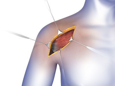 Shoulder Surgery - Educational Picture