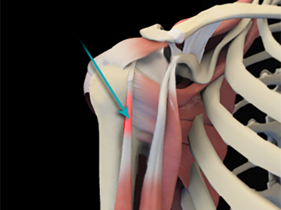 Shoulder Tendonitis - Educational Picture