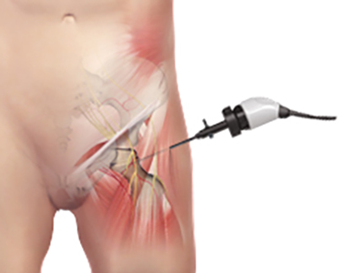Snapping Hip Syndrome - Educational Picture