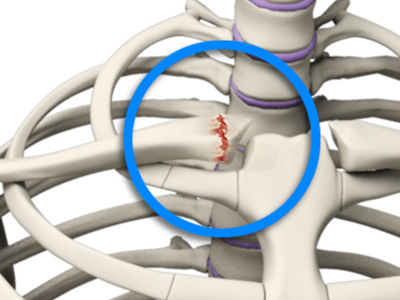 Sternoclavicular Joint Injury - Educational Picture