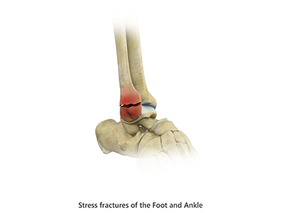 Stress Fractures of Foot and Ankle - Educational Picture