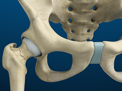 Stress Fractures of the Hip - Educational Picture