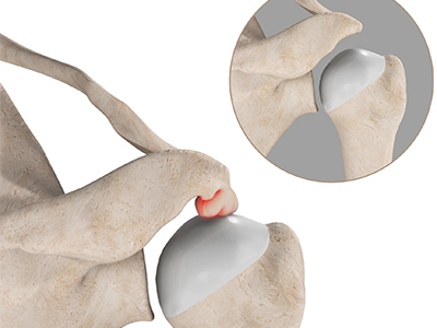 Subacromial Decompression - Educational Picture