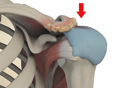 Subacromial Impingement Syndrome - Educational Picture