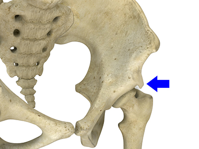 Subspine Impingement - Educational Picture