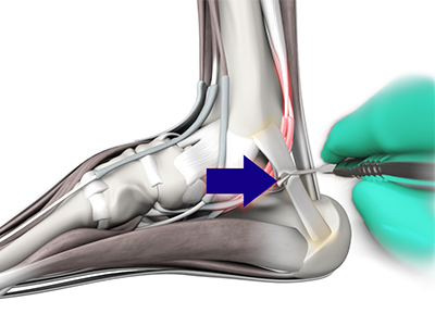 Tarsal Tunnel Syndrome - Educational Picture