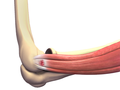 Tennis Elbow - Educational Picture