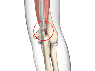 Triceps Injuries - Educational Picture