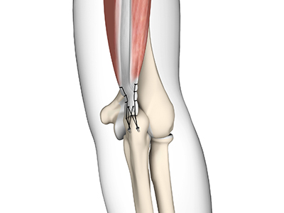 Triceps Repair - Educational Picture