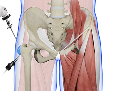 Trochanteric Bursectomy - Educational Picture