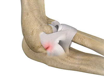 Ulnar Collateral Ligament (UCL) Injury - Educational Picture