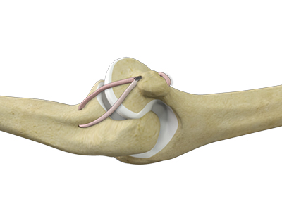 UCL Reconstruction (Tommy John Surgery) - Educational Picture