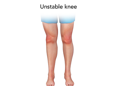Unstable Knee - Educational Picture