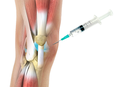 Viscosupplementation - Educational Picture
