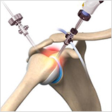 Minimally Invasive Shoulder Replacement - Education Picture