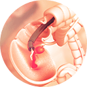 Small Picture of Colon Cancer Screening