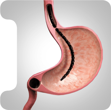 Picture of Upper Gi Endoscopy