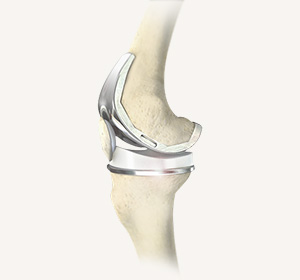 Joint Replacement Service