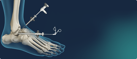 Picture of Ankle Arthroscopy