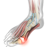 Picture of  Bunions and Toe Pain A close-up of a foot with a prominent red spot on the top