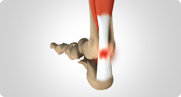Picture of Achilles Tendon Rupture