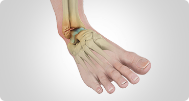 Picture of Ankle Fracture