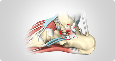 Picture of Ankle Sprain