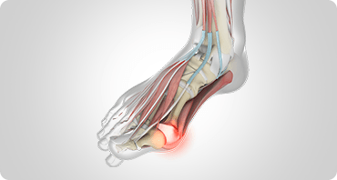 Picture of Bunions & Toe Pain