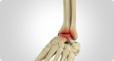 Picture of Foot & Ankle Arthritis Sb