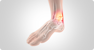 Picture of Foot Fracture