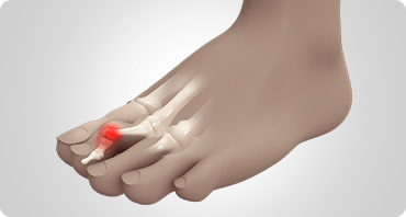 Picture of Hammertoe