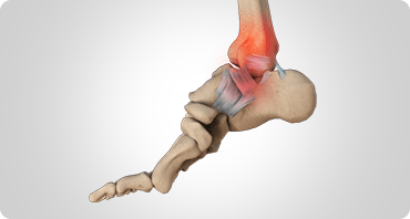 Picture of Heel Pain