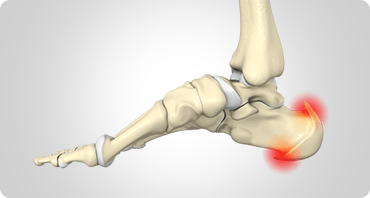 Picture of Heel Spurs