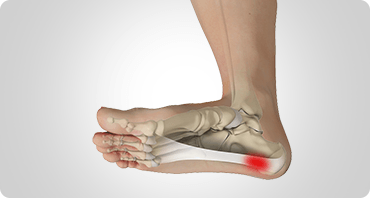 Plantar Fasciitis Sb
