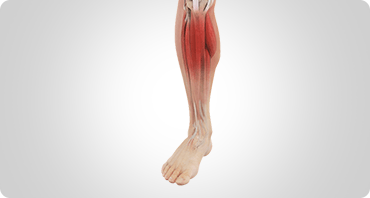Picture of Shin Splints
