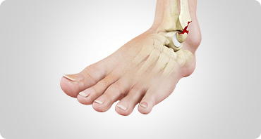 Picture of Stress Fractures of the Foot