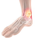 Picture of Foot and Ankle Fractures