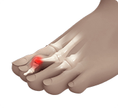 An anatomical representation of a blue foot featuring a bone