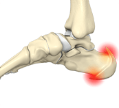 A close-up of a foot showing a red spot on the skin